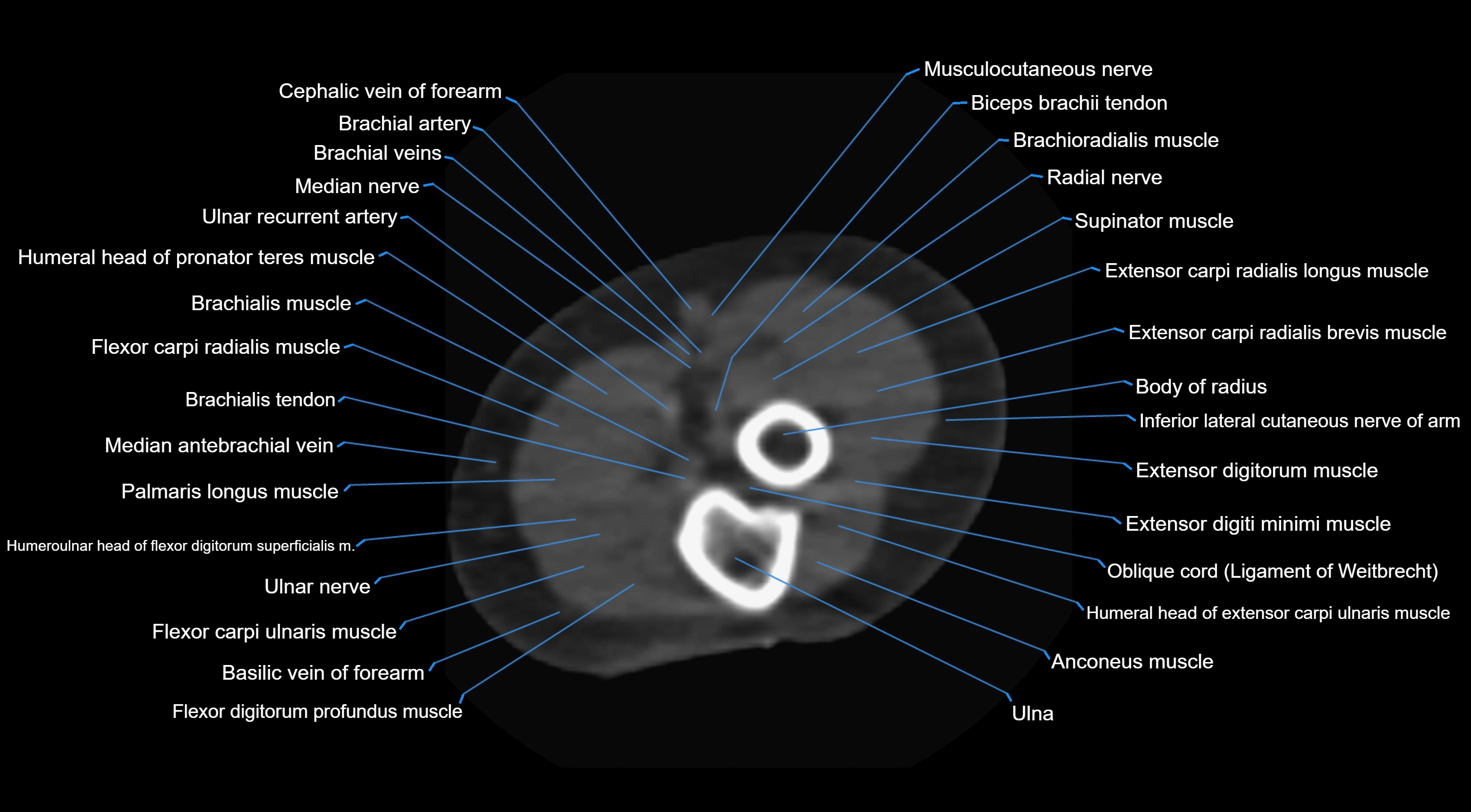CT elbow axial  cross sectional anatomy labelled  radiology image -00037.webp